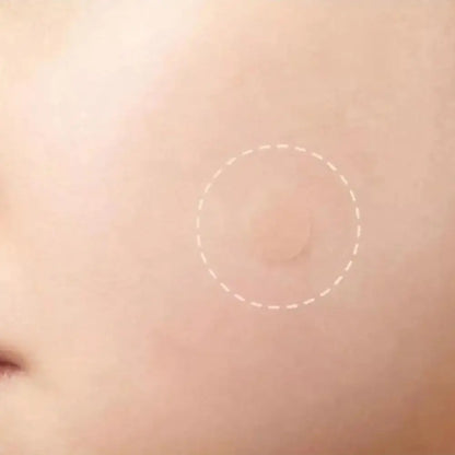 Acne Patch 36 Counts Acne Patches For Covering Zits And Blemishes, Spot Stickers Tea Tree Essential Oil Pimple Patches For Face