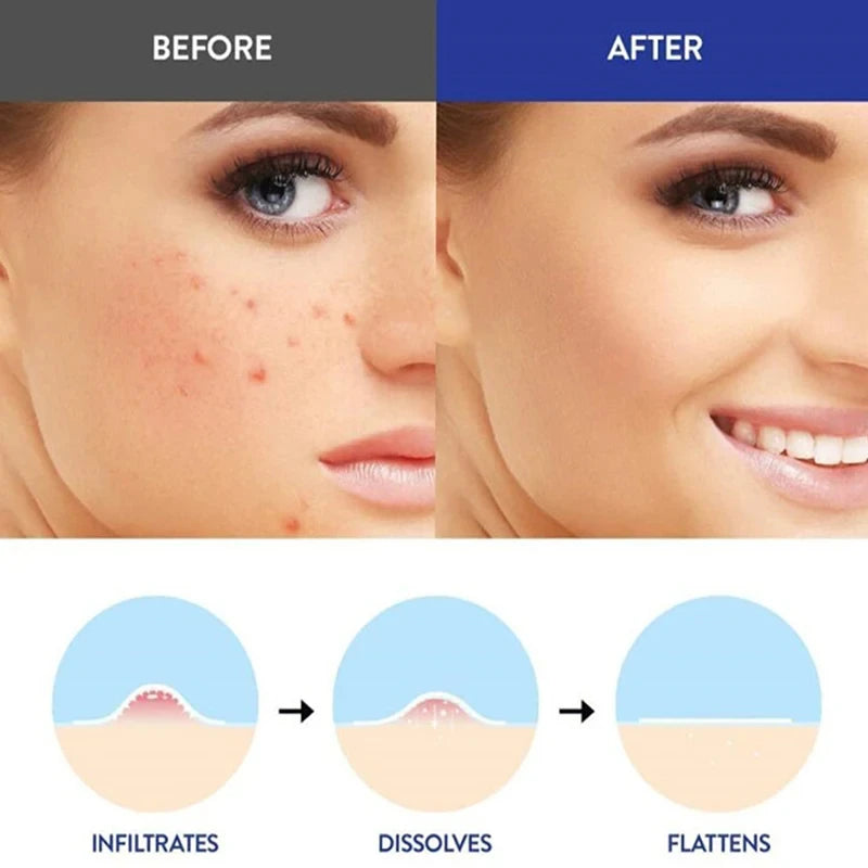 Acne Treatment Invisible Patches Circular Micro Needles 9 Patches per Box Clean Pores Waterproof Made Hydrogel with Microcrystal