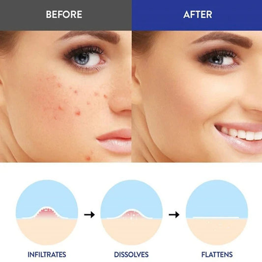 Acne Treatment Invisible Patches Circular Micro Needles 9 Patches per Box Clean Pores Waterproof Made Hydrogel with Microcrystal