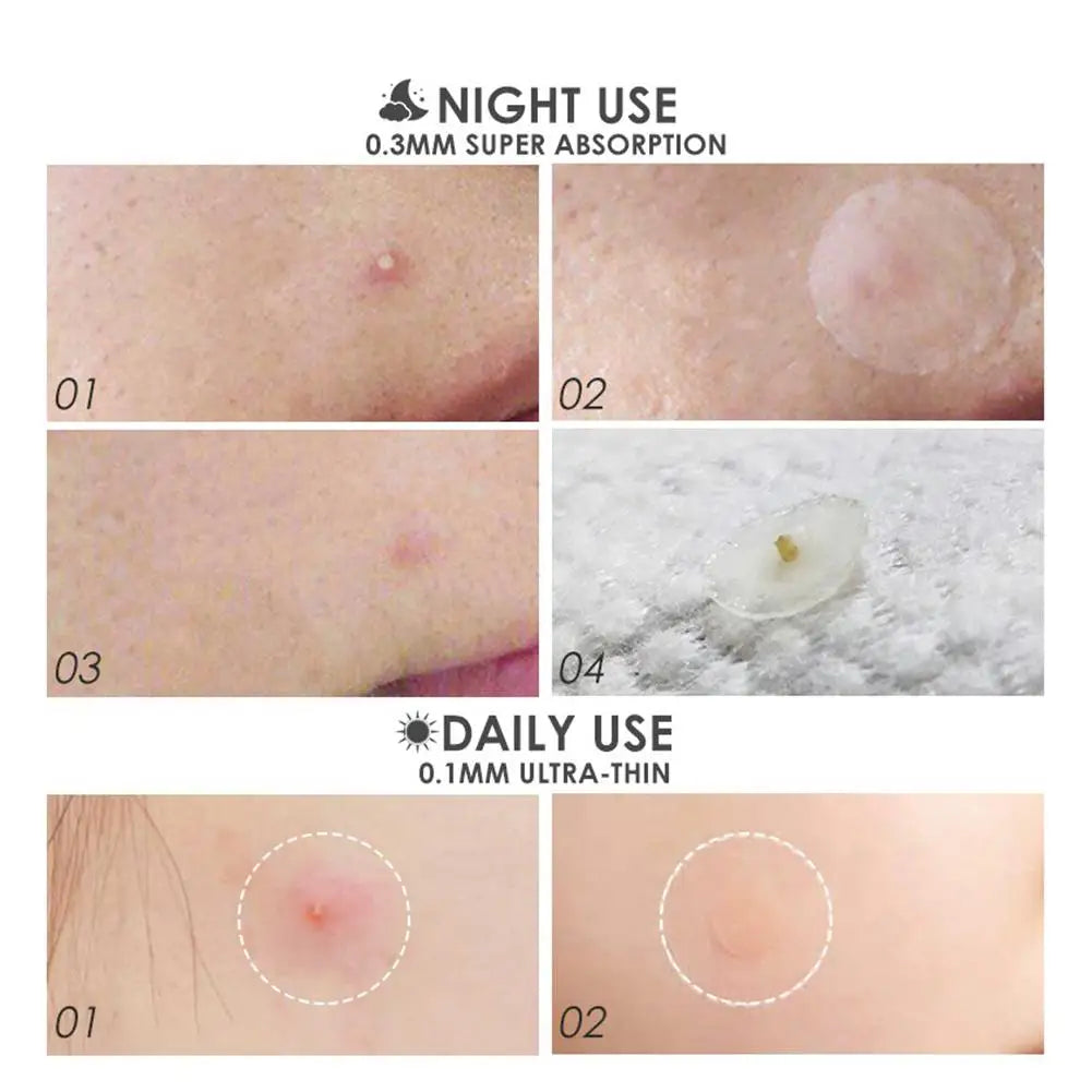 Acne Patch 36 Counts Acne Patches For Covering Zits And Blemishes, Spot Stickers Tea Tree Essential Oil Pimple Patches For Face