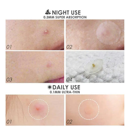 Acne Patch 36 Counts Acne Patches For Covering Zits And Blemishes, Spot Stickers Tea Tree Essential Oil Pimple Patches For Face